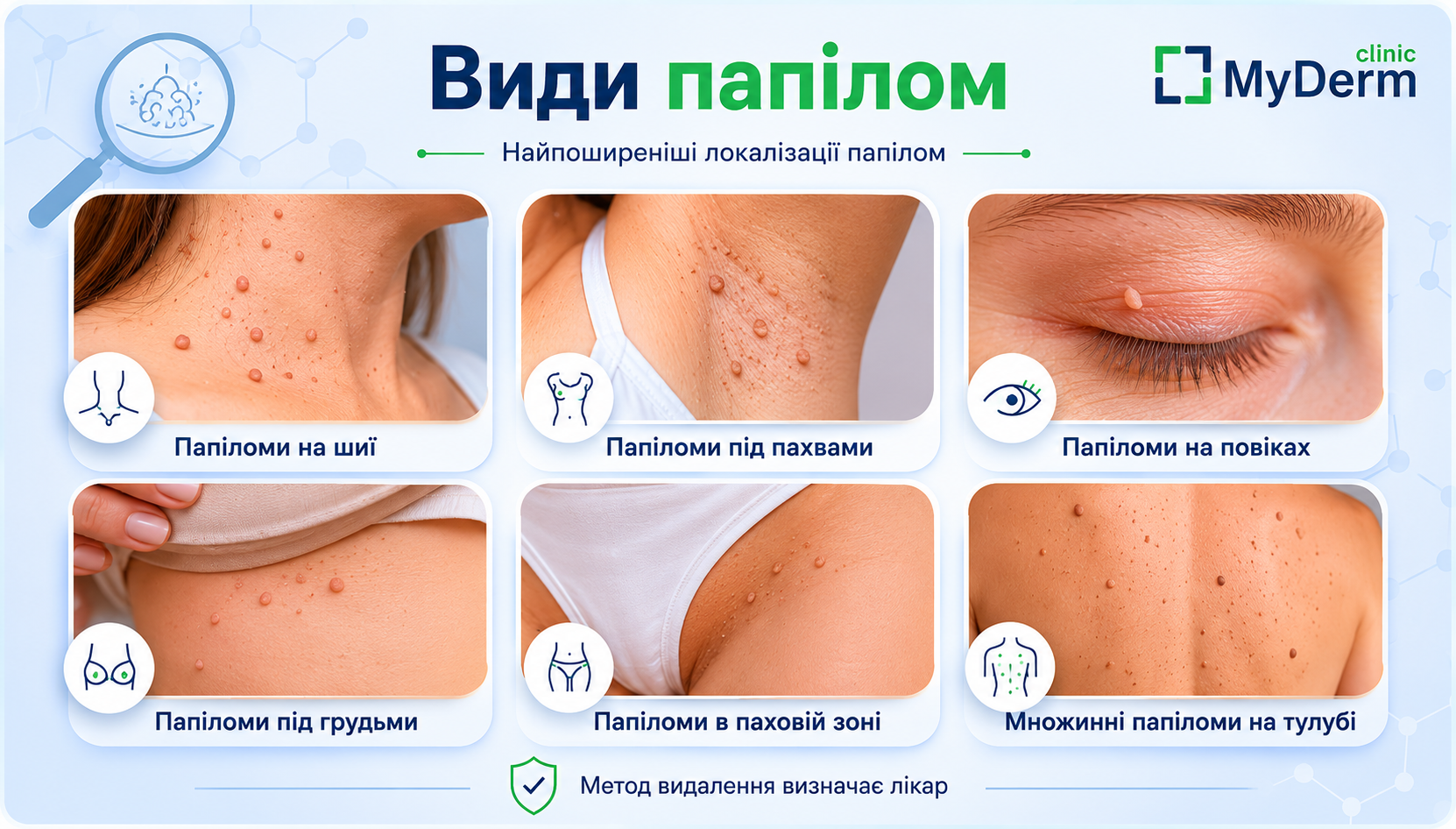папиломы виды
