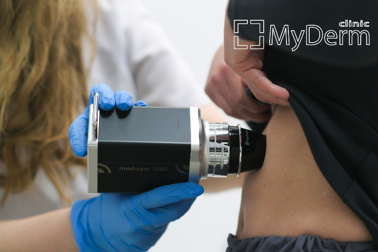 Діагностика базальноклітинного раку шкіри https://mydermclinic.ua/services/bazalioma-diagnostyka-likuvannya/