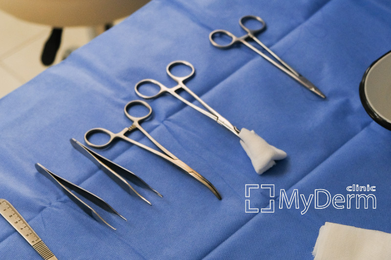 Видалення новоутворень в центрі дерматохірургії MyDerm в Києві 